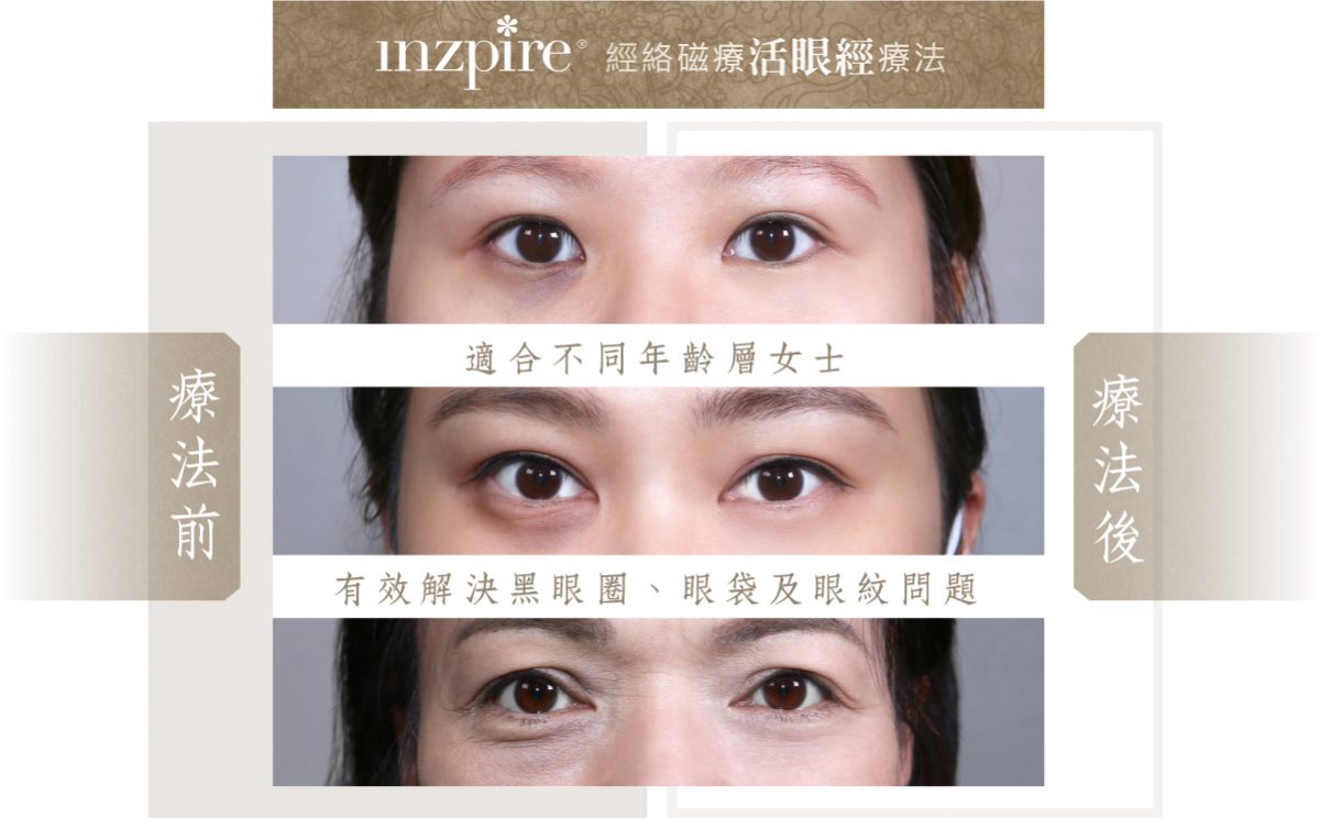 Inzpire經絡磁療活眼經療法 常見眼部問題 去眼袋 去黑眼圈
